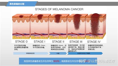 黑色素瘤的分期|【黑色素瘤简介】分期